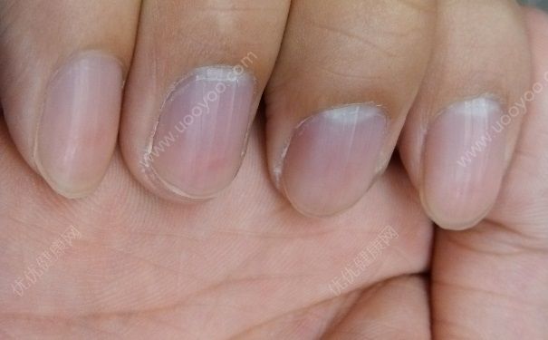 指甲长有黑色竖纹是什么？指甲长有黑色竖纹是怎么回事