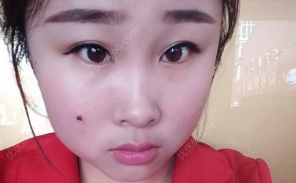 为什么脸上会长痣？什么原因让脸上长痣？(5)