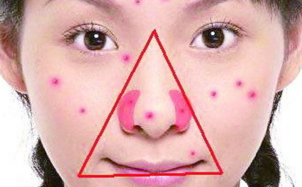 三角区的痘痘为什么不能挤？三角区长痘痘不能挤原因？(1)