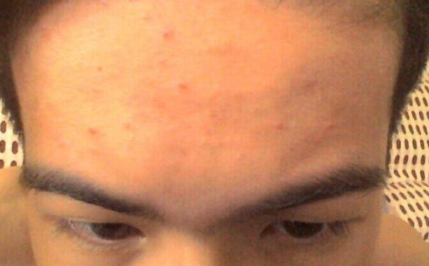 额头油脂分泌旺盛怎么办？额头出油厉害怎么办？(1)