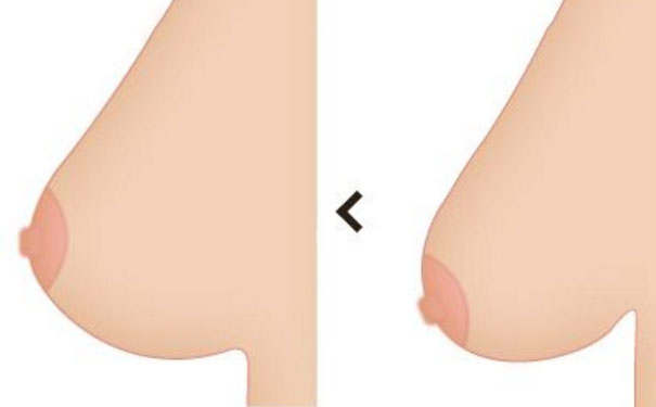 胸部下垂有什么办法调整？胸部下垂怎么调整？[图]