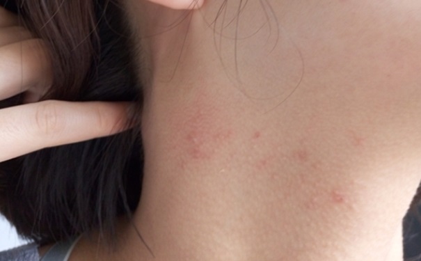 脖子上长痘痘是什么原因？脖子长痘痘是什么原因？(1)