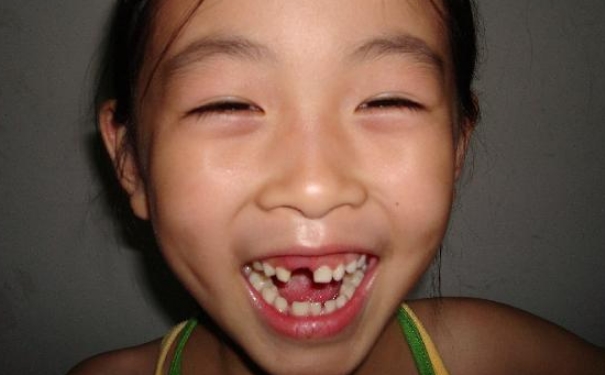 小孩几岁开始换牙？小孩换牙年龄(1)