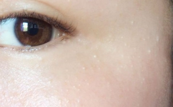 脂肪粒形成的原因是什么？脂肪粒的形成原因及处理办法(1)