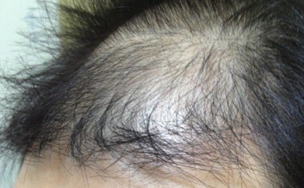 头发稀疏吃什么？吃什么头发浓密乌黑？(1)