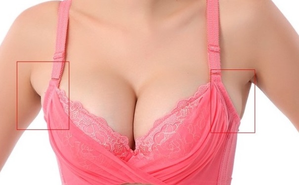 副乳怎么消除？副乳要怎么去掉？[图]