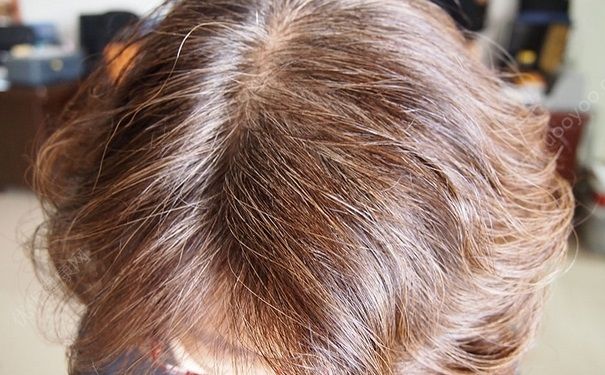 17岁吃黑芝麻能让头发变黑吗？吃黑芝麻有什么功效？(2)
