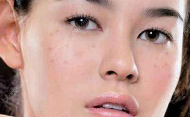 月经不调脸上会长斑吗？月经不调脸上长斑怎么办？(2)