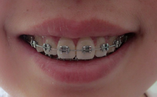 牙套要带多久？戴牙套一般要多久才有效果？[图]