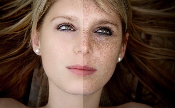 脸上长斑怎么办？脸上长斑怎样去掉？(1)