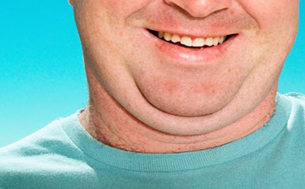 双下巴是怎么形成的？不胖为什么有双下巴？(1)