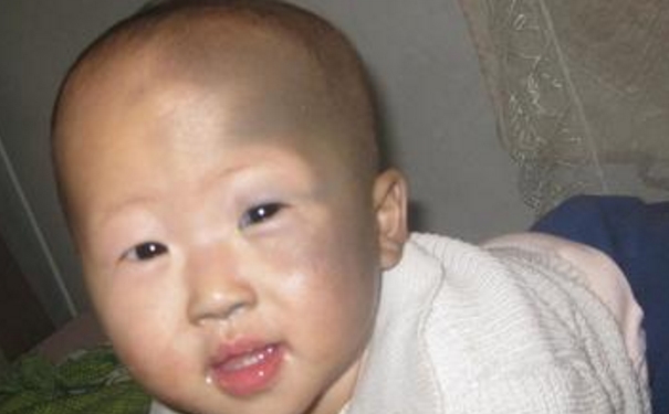 宝宝青色胎记会消失吗？宝宝身上的青色胎记会消退吗？(1)