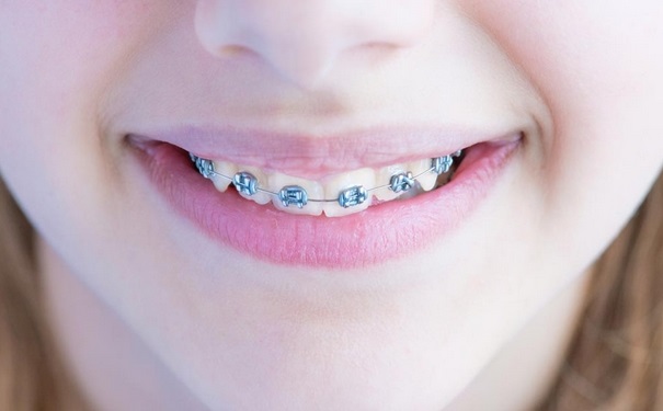 戴牙套会影响到怀孕吗？怀孕了能不能戴牙套？(1)