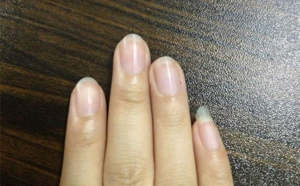 手指甲上的月牙代表什么？手指甲上月牙没了怎么回事？[
