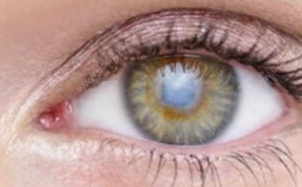 视网膜动脉硬化严重吗？视网膜动脉硬化治疗(1)