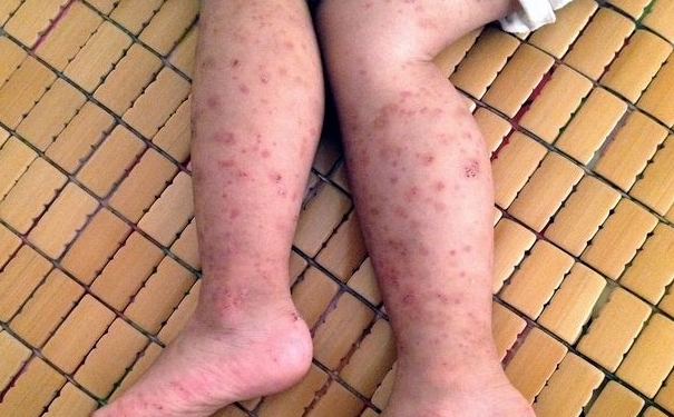 紫癜痊愈后应注意什么？紫癜治愈后注意事项有哪些？[图]