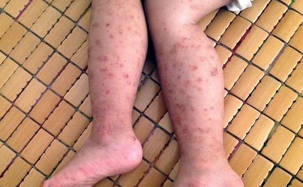 紫癜前期症状有哪些？紫癜的早期症状？[图]