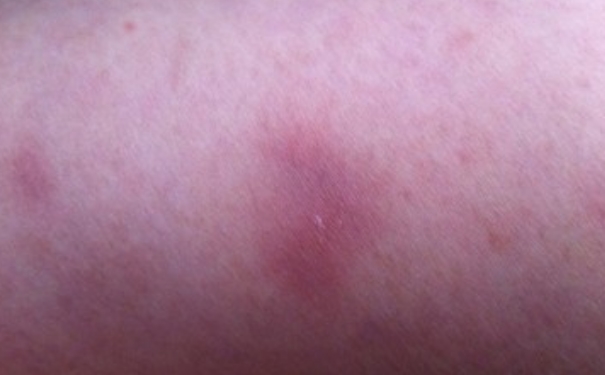 紫癜是什么引起的？紫癜引起原因是什么？[图]