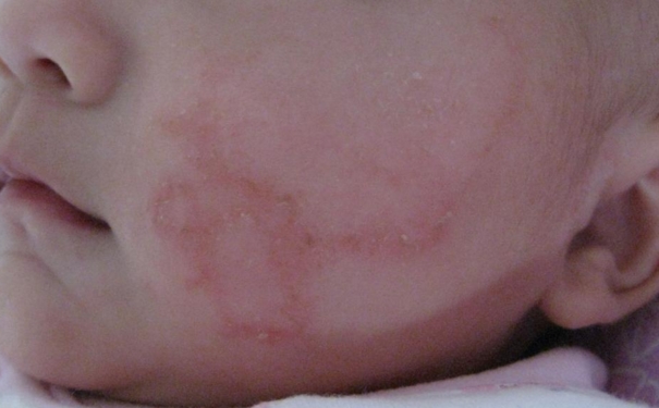 湿疹能用盐水洗吗？湿疹可以用盐水洗吗？[图]