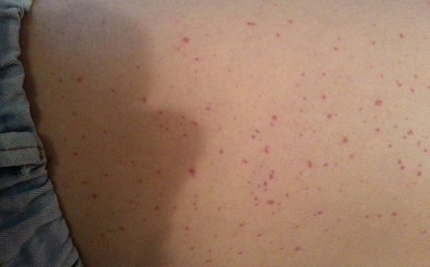 紫癜的症状有哪些？紫癜有哪些症状？[图]