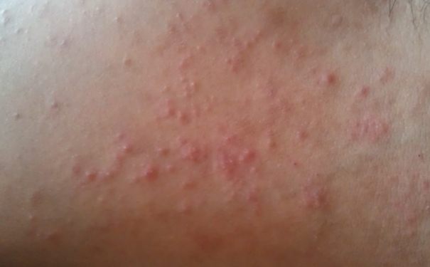 湿疹为什么晚上特别痒？湿疹晚上特别痒的原因？[图]