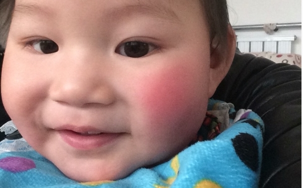 冬天小孩脸红扑扑的是什么原因？小孩冬天脸红怎么回事