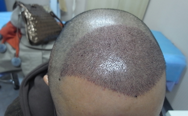 种植头发要多长时间？种植头发需要多久？[图]