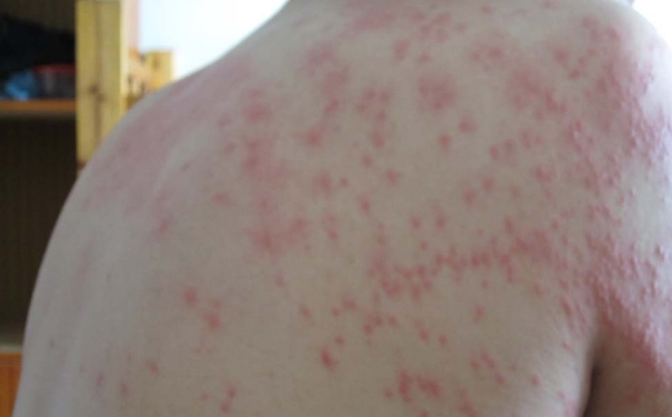 风疹会不会传染人？风疹有传染性吗？[图]