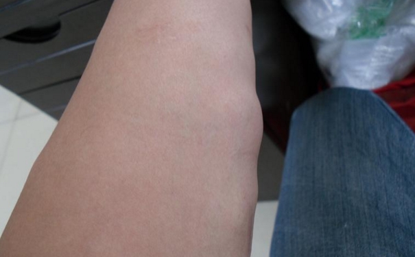 脂肪瘤会传染吗？脂肪瘤具有传染性吗？[图]