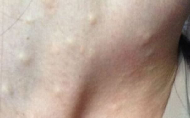 脂肪瘤变大了怎么办？脂肪瘤长得快怎么办？[图]