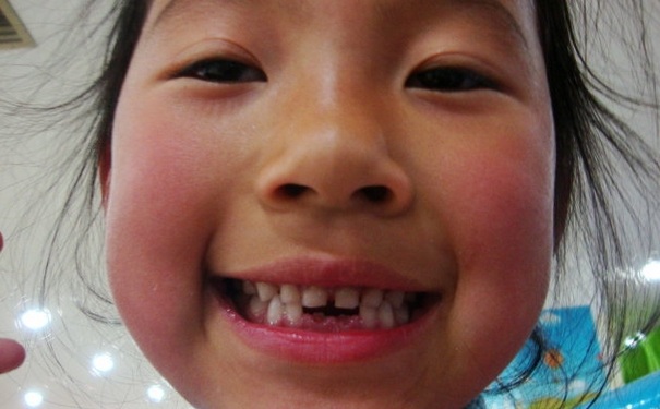 小孩换牙乳牙不掉怎么办？小孩换牙老不掉怎么办？(1)