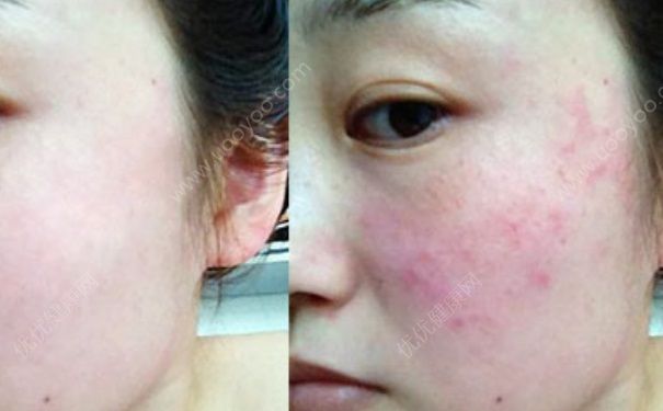 敏感性红血丝用什么护肤品？脸上有红血丝可以用芦荟胶吗？(1)