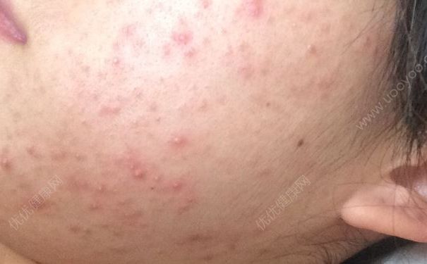 女子挤痘半边脸肿胀，挤痘有什么坏处？(2)