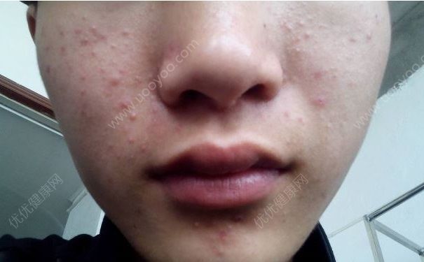 女子挤痘半边脸肿胀，挤痘有什么坏处？(4)