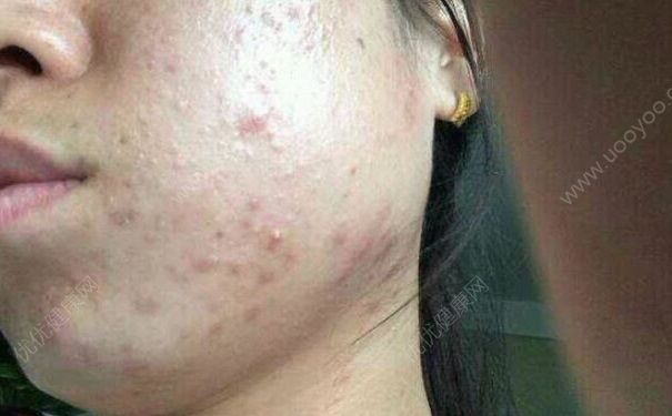 女子挤痘半边脸肿胀，挤痘有什么坏处？(3)