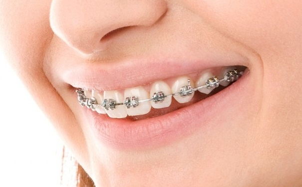 牙齿矫正会反弹吗？怎样防止牙齿矫正后反弹？[图]