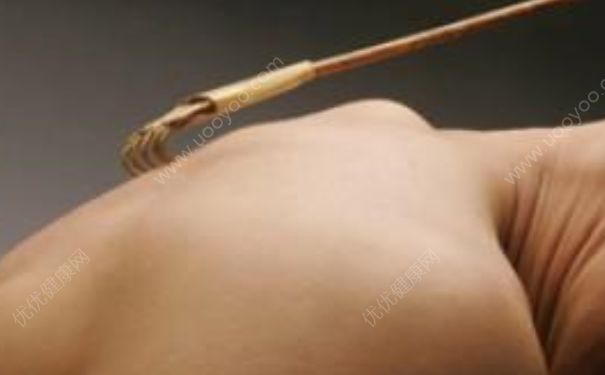 皮肤瘙痒的原因有哪些？缓解皮肤瘙痒的方法？(1)