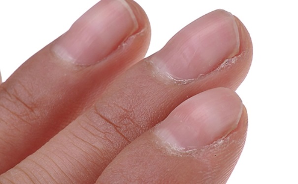 指甲为什么会发黑？指甲发黑该怎么办？(1)