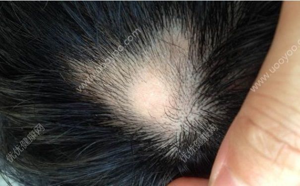 斑秃怎么治疗？斑秃怎么治疗比较好？(1)