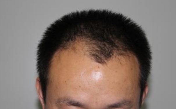 植发后要注意什么？植发后应该怎么洗头？(1)