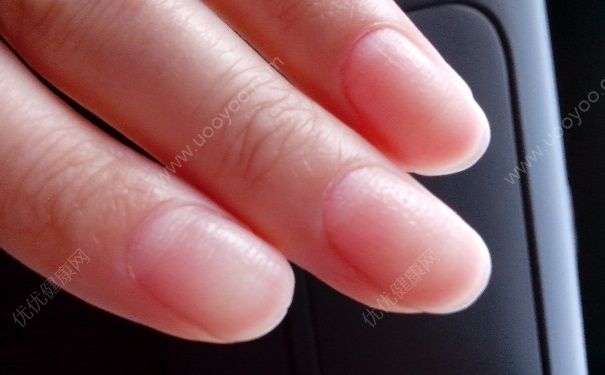 灰指甲治疗有何有效偏方？预防灰指甲该怎么做？(1)