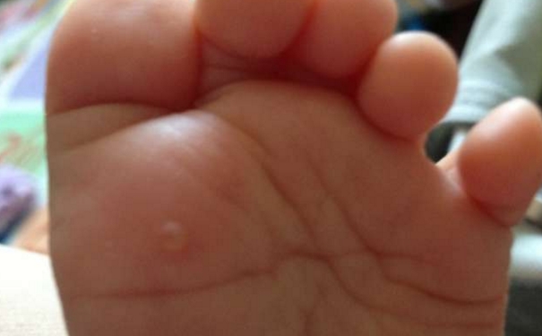 脚上起水泡了来怎么办？脚上起水泡很痒怎么办？(1)