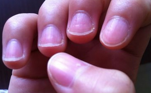 指甲盖凹凸不平缺什么？指甲不平缺什么？[图]