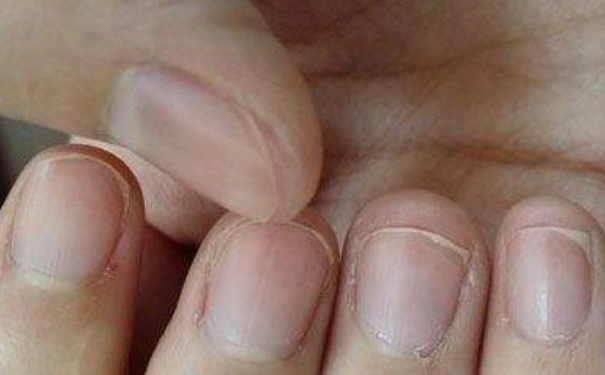 怎样通过指甲看身体健康状况？怎样从指甲看出男人肾虚