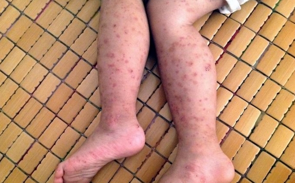 紫癜为什么会反复发作？紫癜一直出怎么回事？[图]