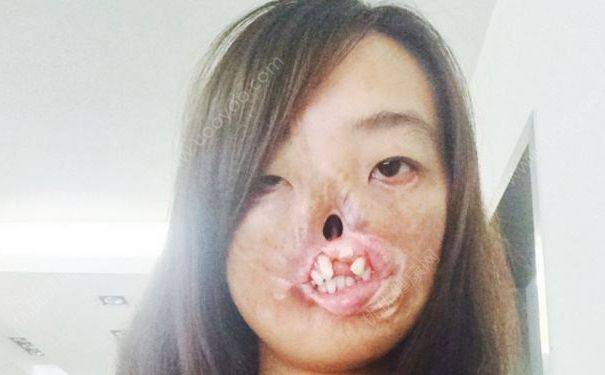 27岁女子换脸，发烧会导致毁容吗？(2)