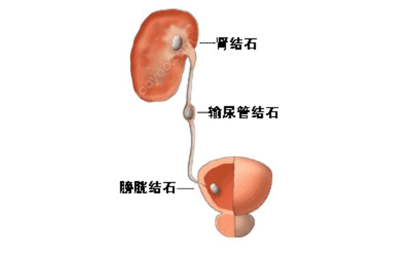 膀胱结石手术治疗会有效吗？膀胱结石手术治疗的效果(1)