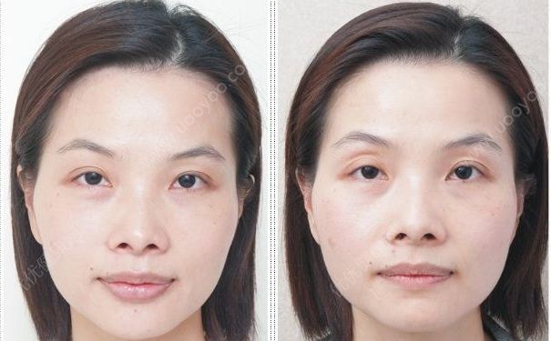 眼窝凹陷是哪些原因引起的？如何矫正眼窝凹陷？(1)