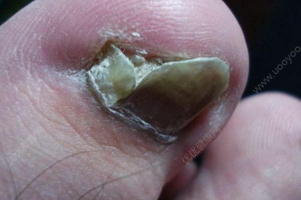 脚趾甲长肉里很痛怎么办？这样做帮你搞定[图]