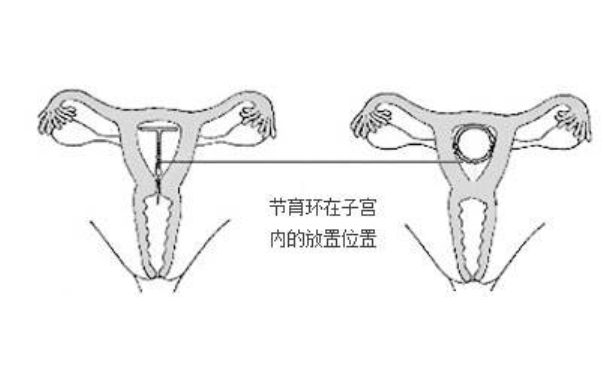 女性结扎手术什么时候做？结扎手术什么时候做最佳？(1)